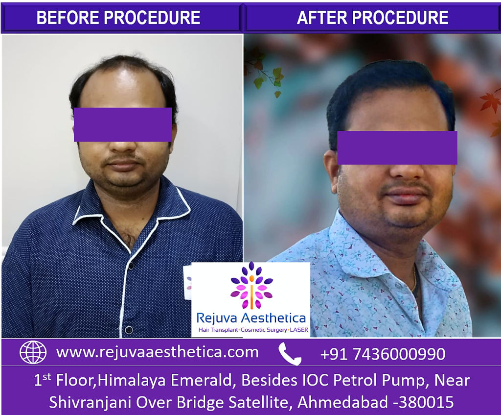 Best Hair transplant Clinic in Ahmedabad,Gujarat