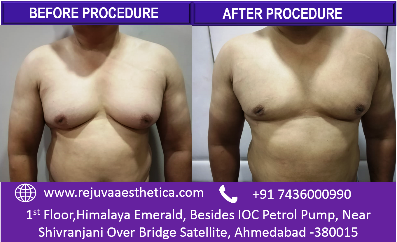 Gynecomastia Treatment Before after Image