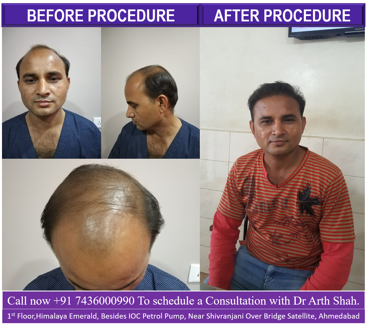 before after hair transplantation