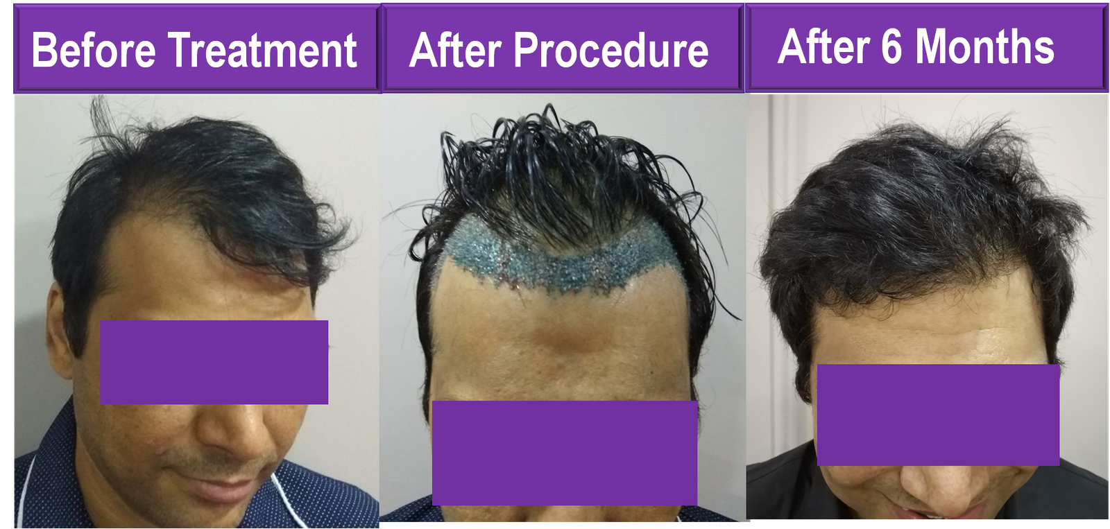 before after long hair transplant