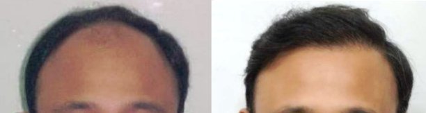 before-and-after-hair-transplant-india