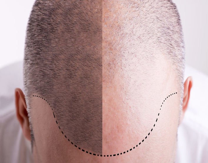 Hair transplant cost in ahmedabad
