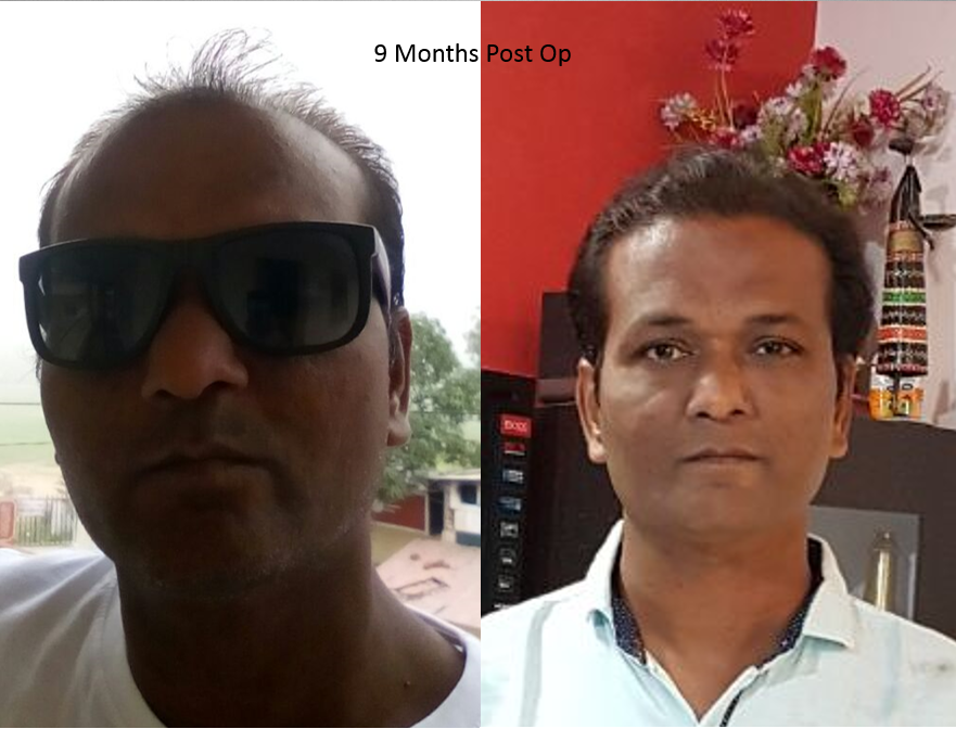 hair transplant in ahmedabad