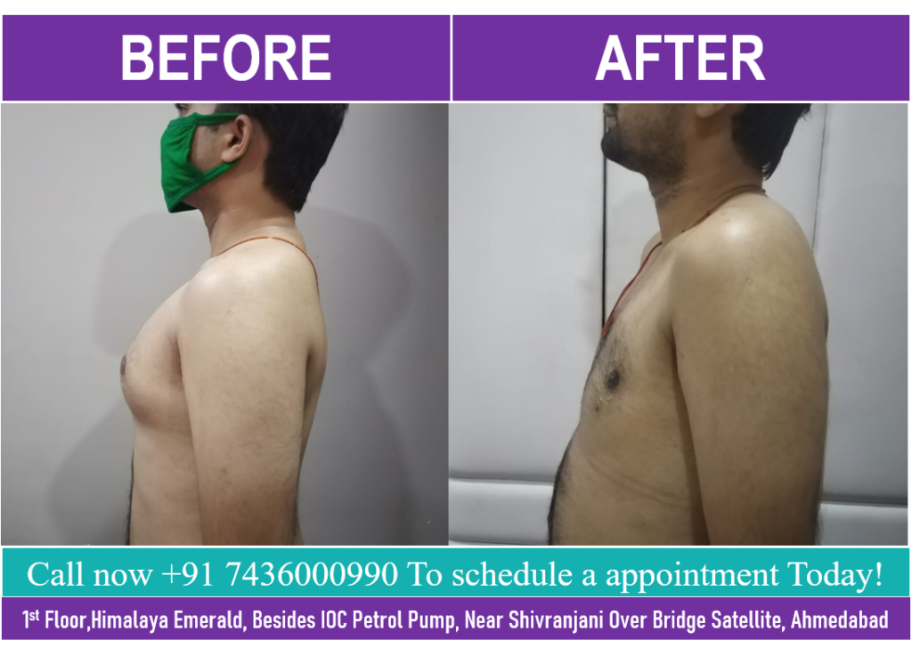 गाइनेकोमैस्टिया प्रोसीजर करने मै कितना खर्चा आएगा जानिए प्लास्टिक सर्जन से l  Cost of Gynecomastia.