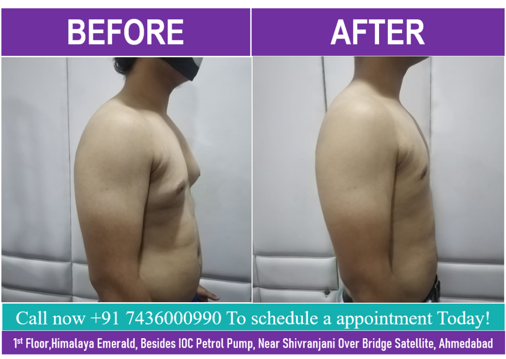 Can Gynecomastia Go away without Surgery, Lets Learn about it with India’s top Plastic Surgeon