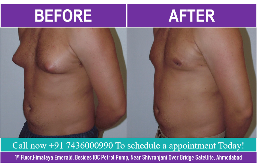 PATIENT SUFFERING FROM GYNECOMASTIA FOR PAST 29 YRS GOT HIS GYNECOMASTIA TREATMENT DONE AT OUR CLINIC IN GUJARAT