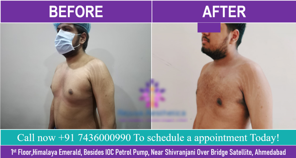 यूट्यूब के मरीज़ कहते हैं कि यह गाइनोकोमास्टिया इलाज के लिए सबसे अच्छा क्लिनिक हैअहमदाबाद,गुजरात में