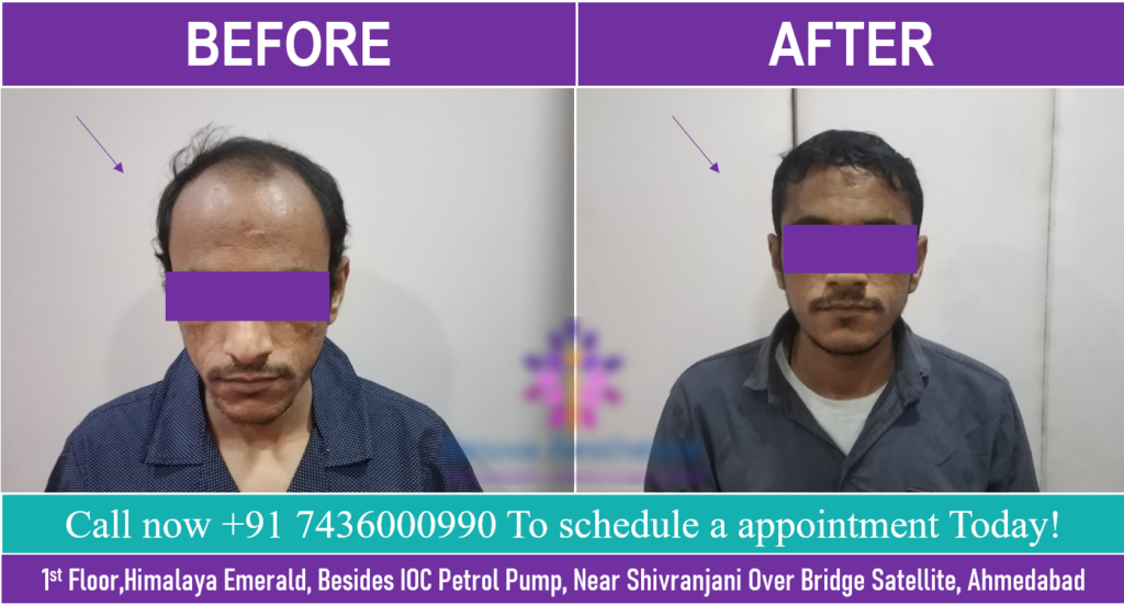 29-YEAR-OLD PATIENT’S Hair Transplant Clinic in Ahmedabad TESTIMONIAL FOR HAIR TRANSPLANT SURGERY IN AHMEDABAD, GUJARAT