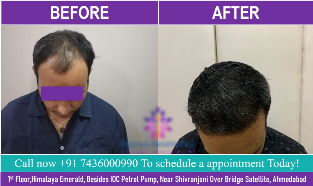 Best Natural Looking Hair Transplant Results of 2020 | 9 Months after Hair Transplant Surgery patient from Gujarat
