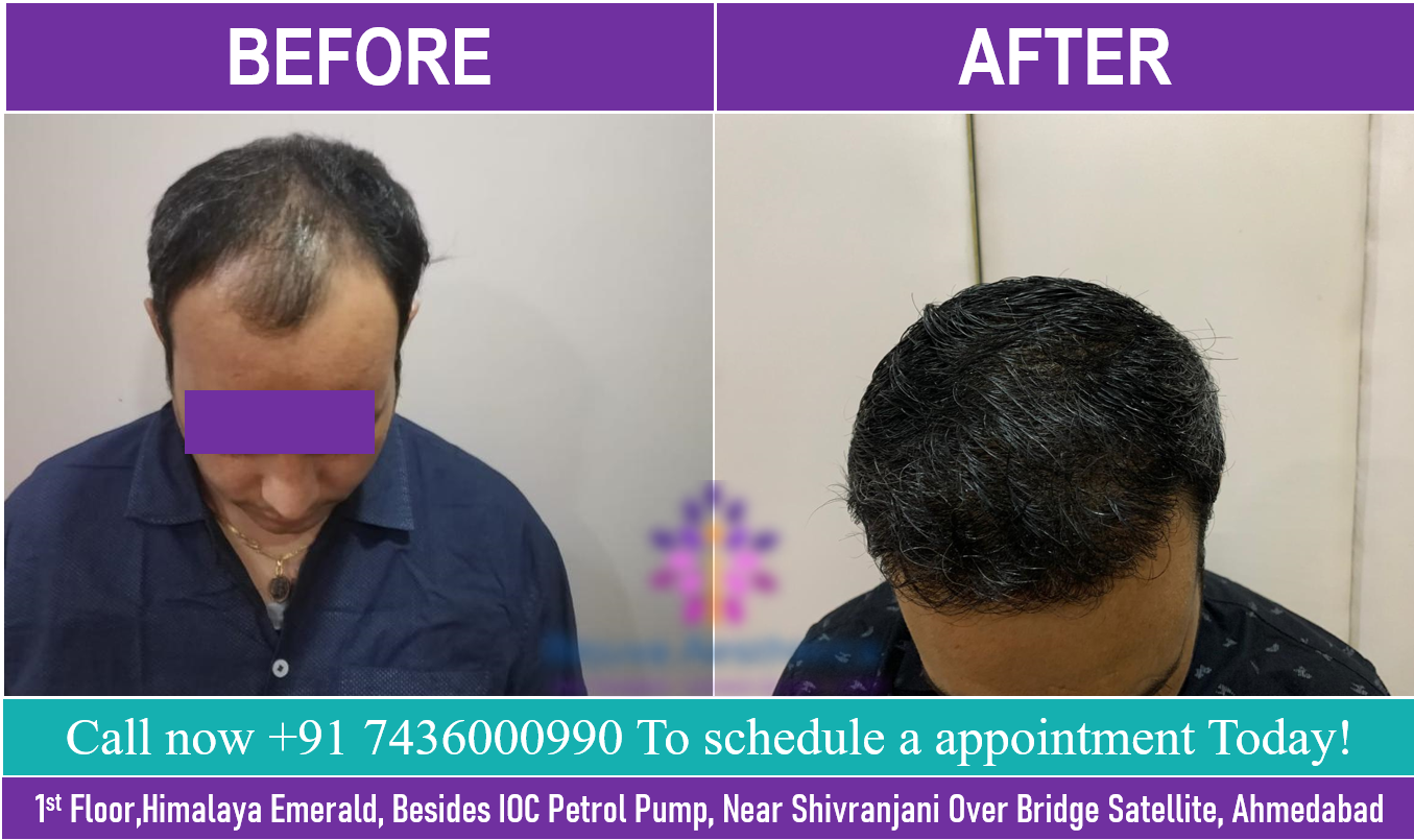 best hair transplant clinics in ahmedabad