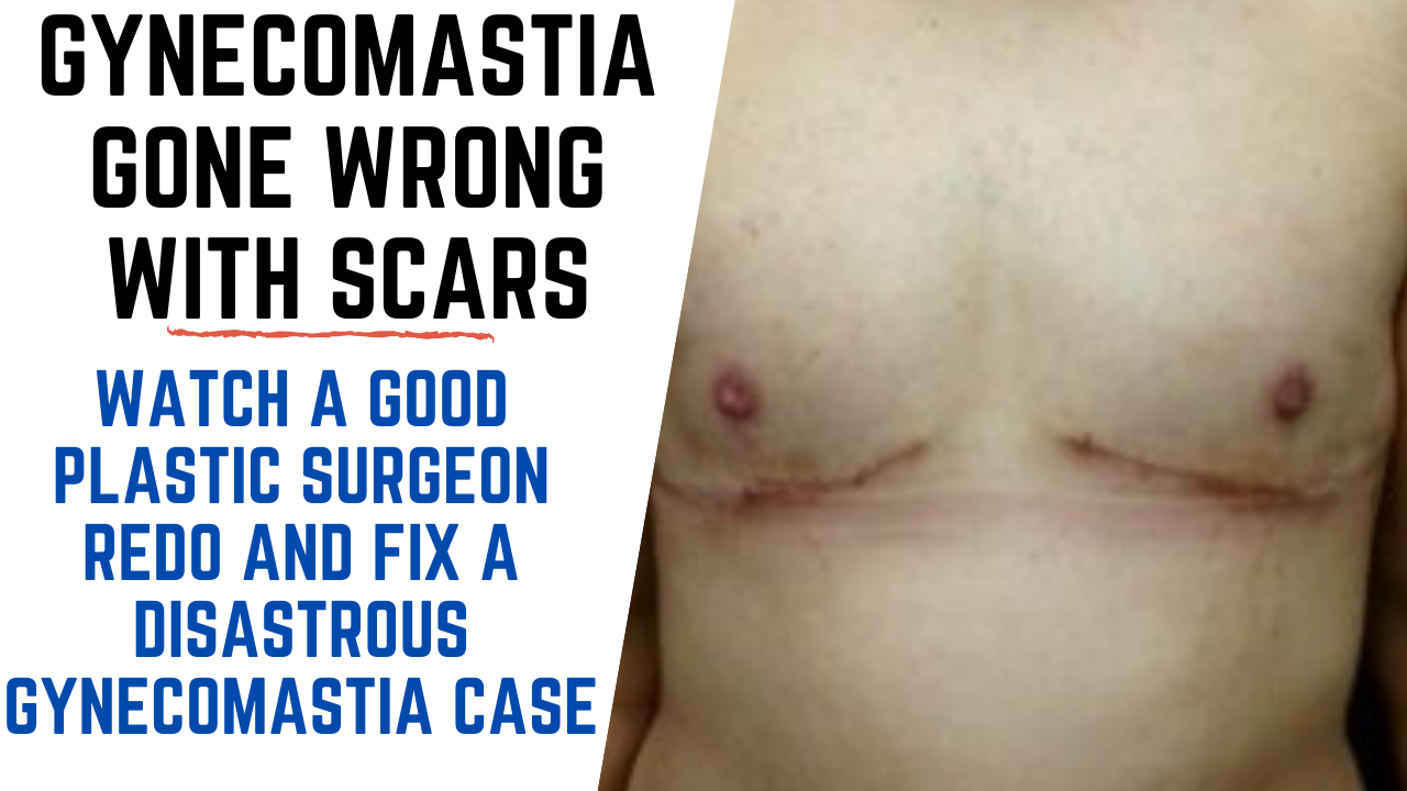 FIXING A DISASTROUS GYNECOMASTIA CASE PERFORMED BY NON QUALIFIED DOCTOR Botched Gynecomastia Surgery