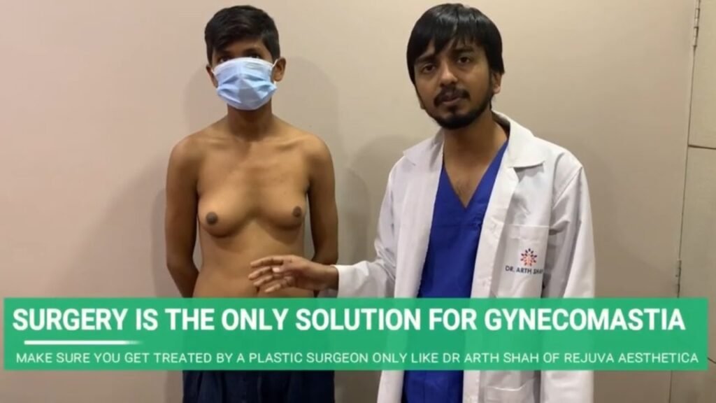 UNIQUE CASE OF UNILATERAL ONE SIDED GYNECOMASTIA WITH THE BEST GYNECOMASTIA SURGEON IN INDIA