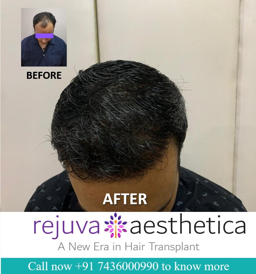 A new Era in Hair Transplant with Rejuva Aesthetica Incredible results See it to believe it