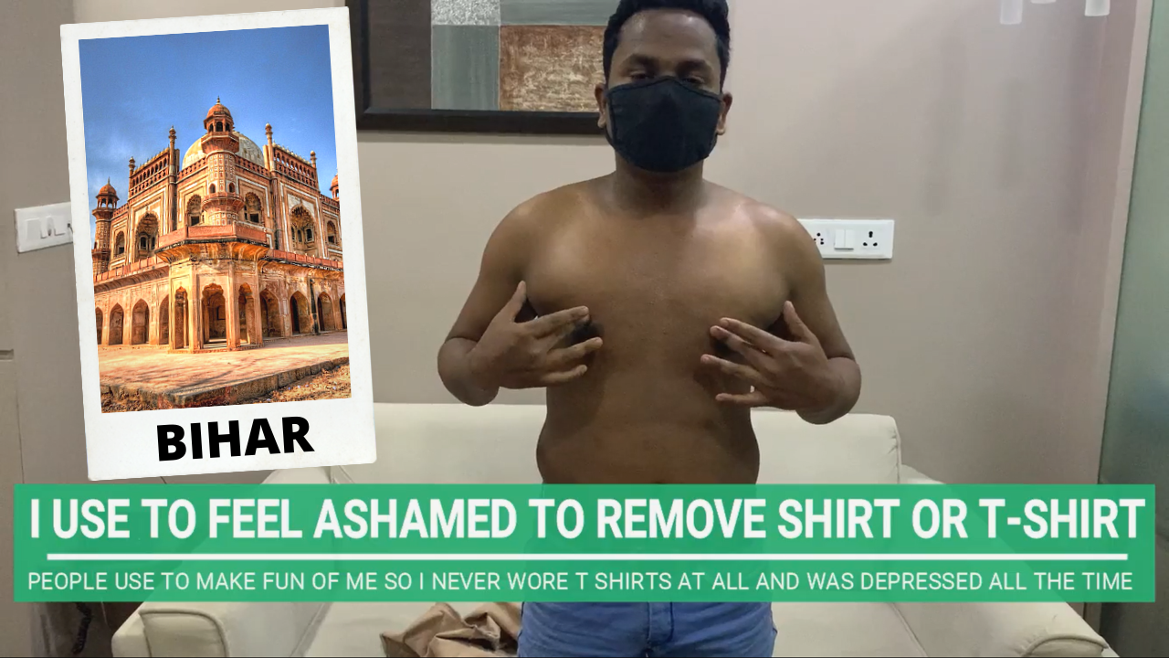 Patient from Bihar, Uttar Pradesh came to Ahmedabad, Gujarat to get treated for Gynecomastia by Best Plastic Surgeon in India