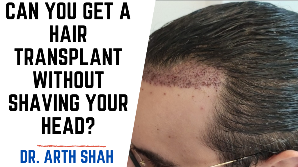 Hair Transplant Without Shaving in Ahmedabad,Gujarat l Unshaven & Long Hair Transplant in India