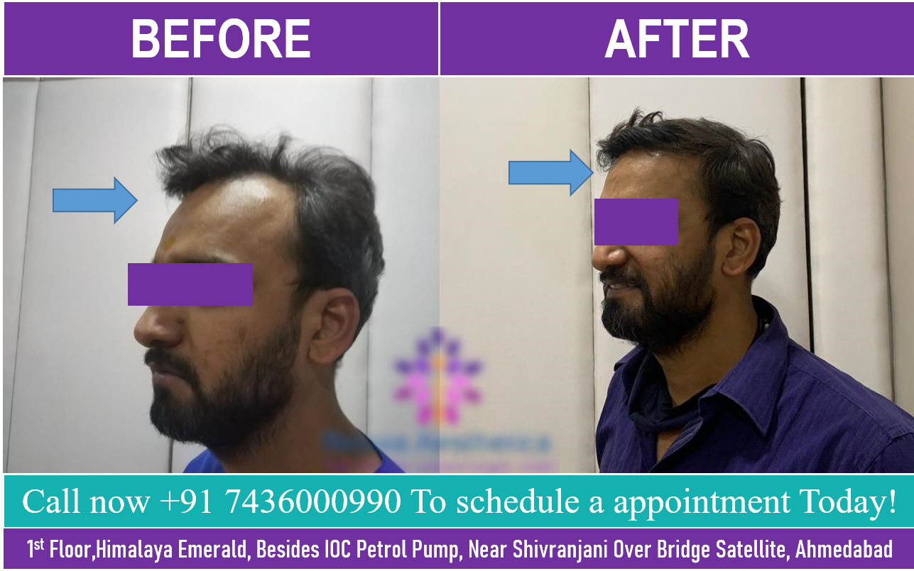 Best Hair Transplant clinics in Surat