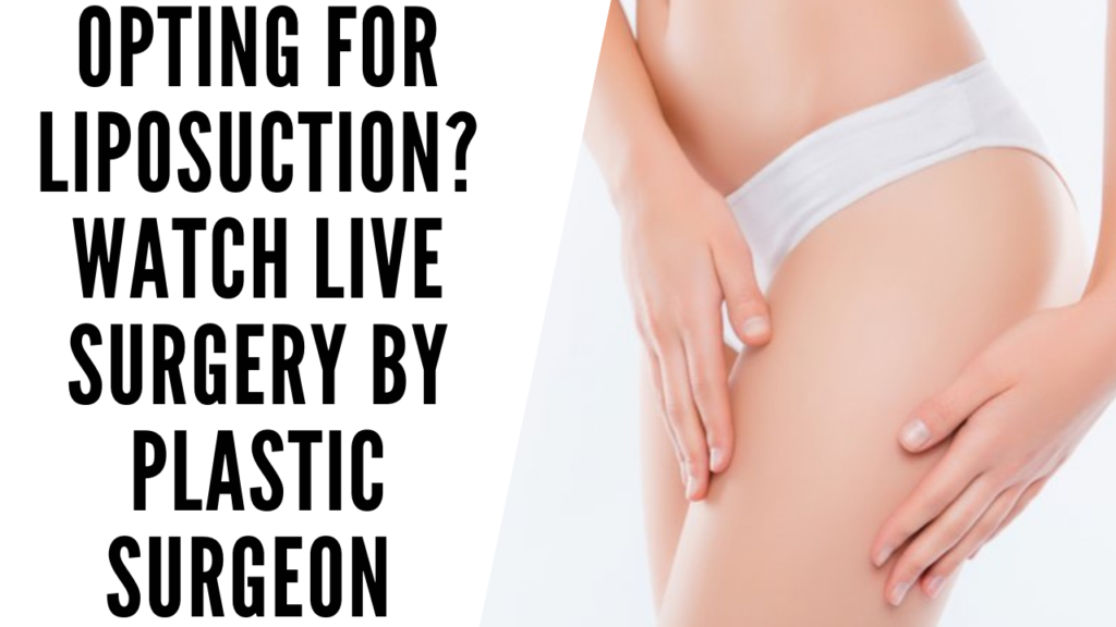 THINKING OR OPTING FOR LIPOSUCTION WATCH LIVE PROCEDURE OF THIGH LIPOSUCTION