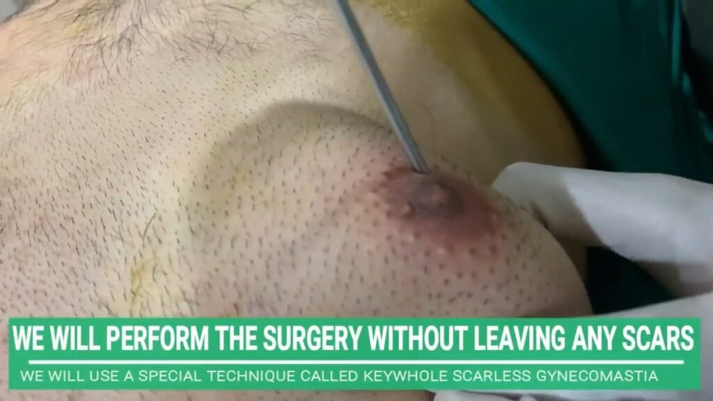 ONE-SIDED MALE CHEST REDUCTION SURGERY LIVE UNILATERAL AKA ONE SIDED GYNECOMASTIA SURGERY IN INDIA