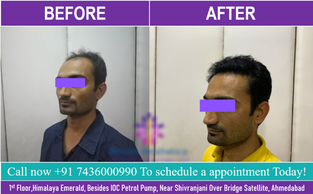 Best Hair Transplant Clinic in Ahmedabad