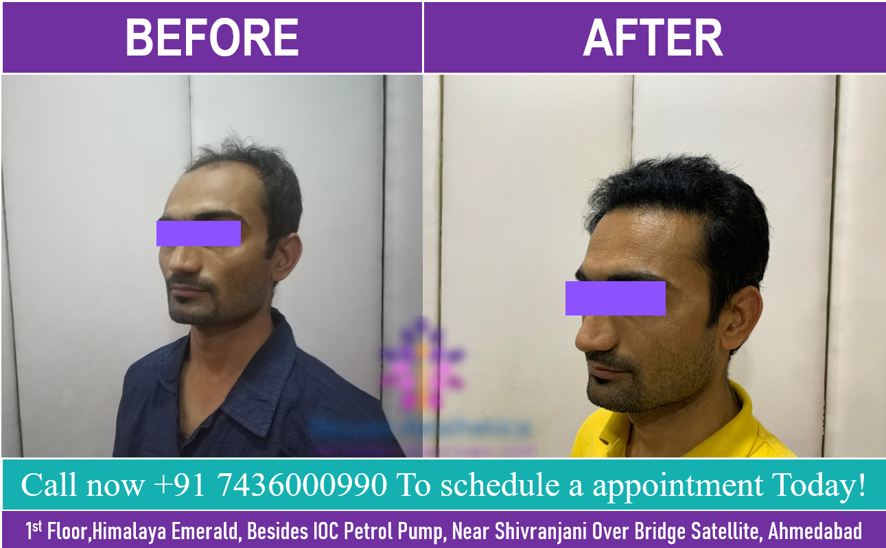 Hair Transplant in Ahemdabad  Best Hair Loss Treatement Clinic