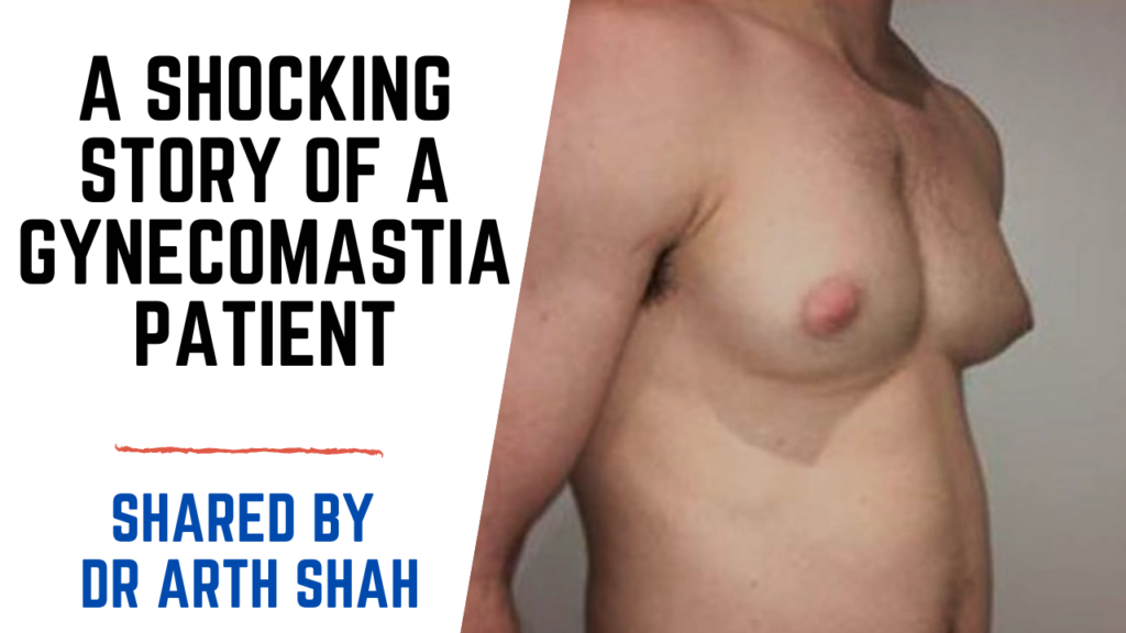 PATIENT TESTIMONIAL FOR GYNECOMASTIA SURGERY IN GUJARAT