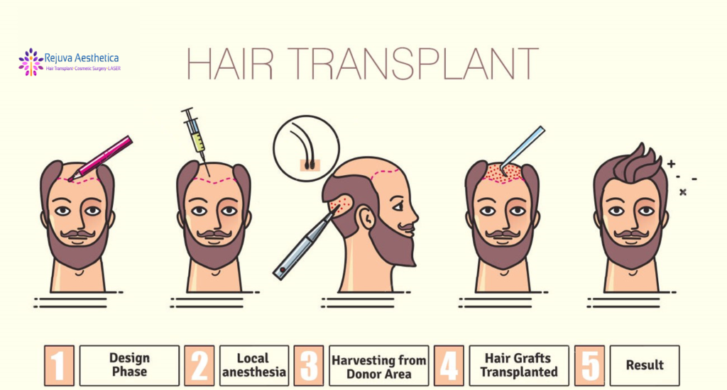 Hair Transplant Process in Ahmedabad,Gujarat
