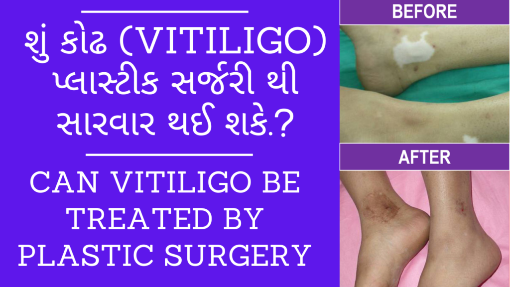 Can Vitiligo be Treated by Plastic Surgery | TISSUE GRAFTS IN VITILIGO SURGERY
