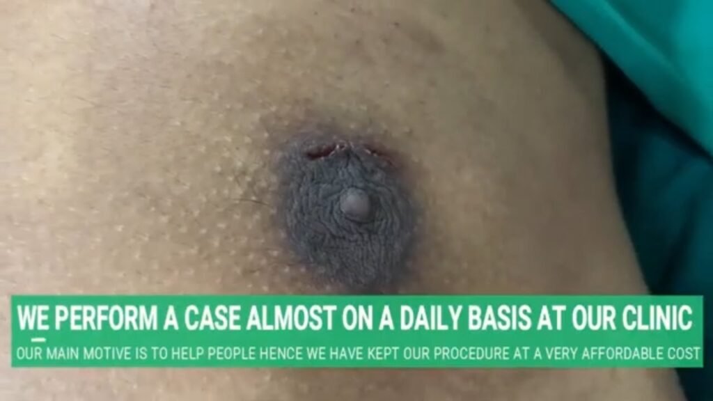 PUFFY NIPPLE SURGERY RESULTS WITH SCARLESS KEYHOLE GYNECOMASTIA TECHNIQUE BY DR ARTH SHAH