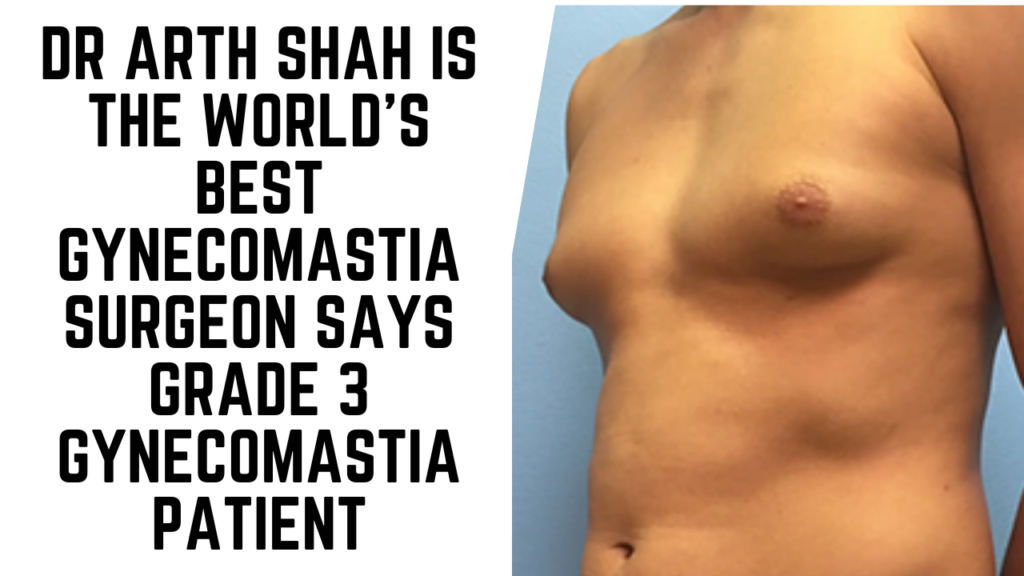 Dr Arth Shah is the World’s Best Gynecomastia Surgeon Says Grade 3 Gynecomastia Patient