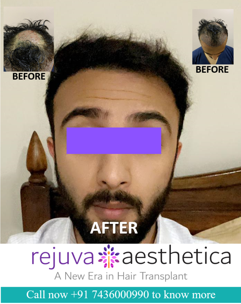 Best Hair Transplant and Alopecia Clinic in Ahmedabad Gujarat, India
