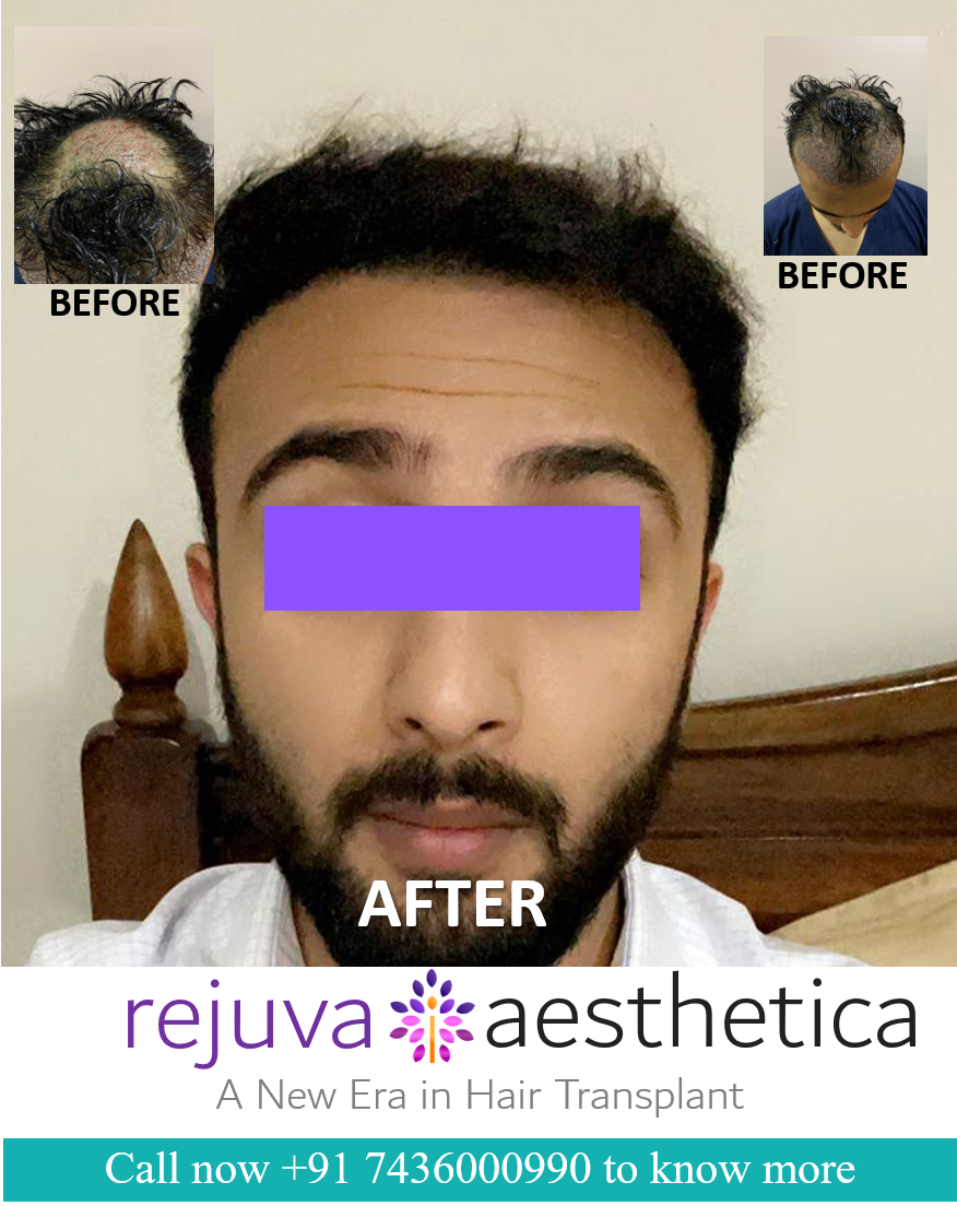 Which is the best hair transplant clinic in Ahmedabad