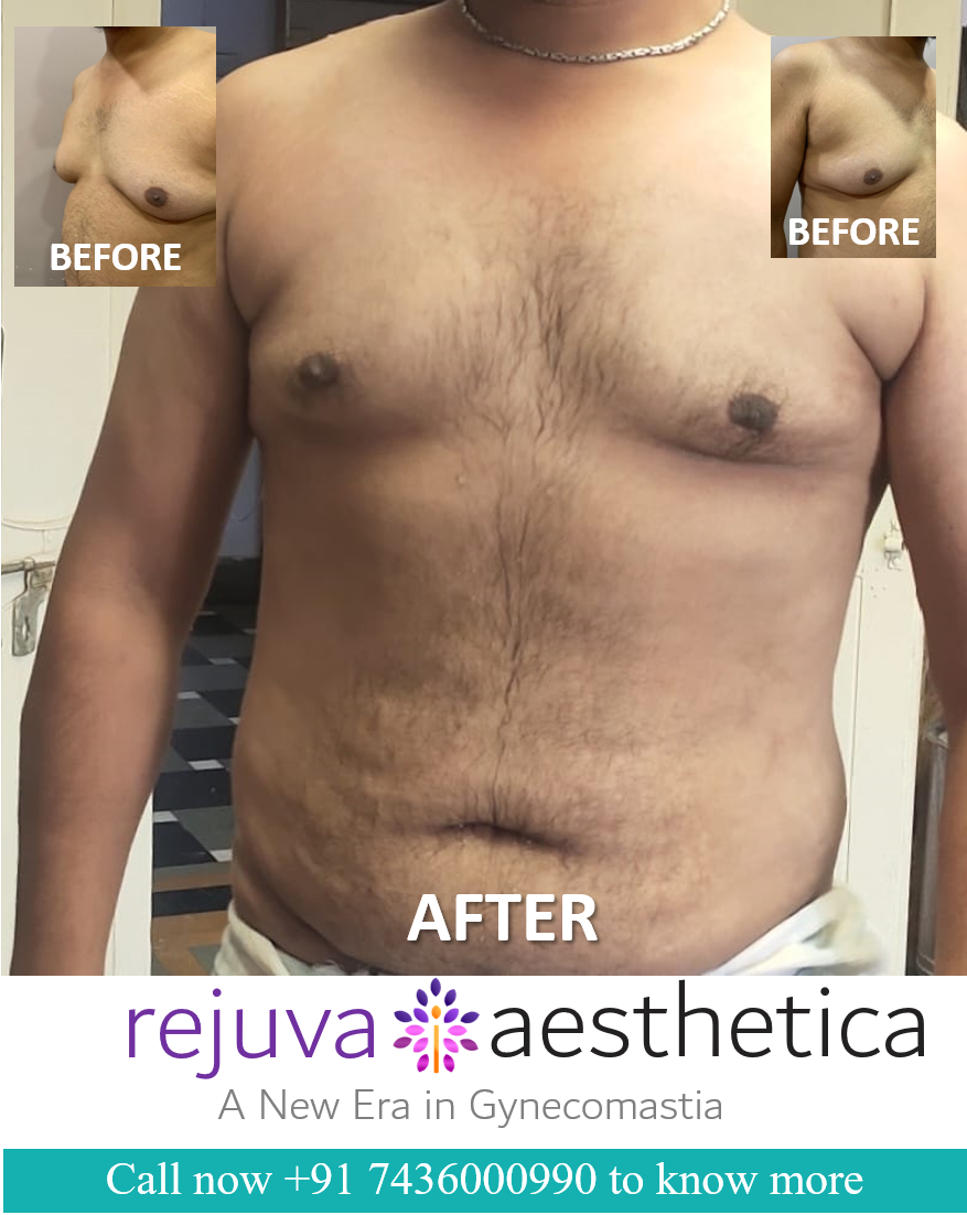 Unilateral One side Gynecomastia Complete Surgery video by Dr