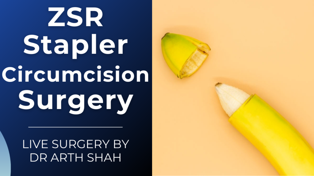 ZSR Stapler Circumcision Surgery in Ahmedabad, Gujarat