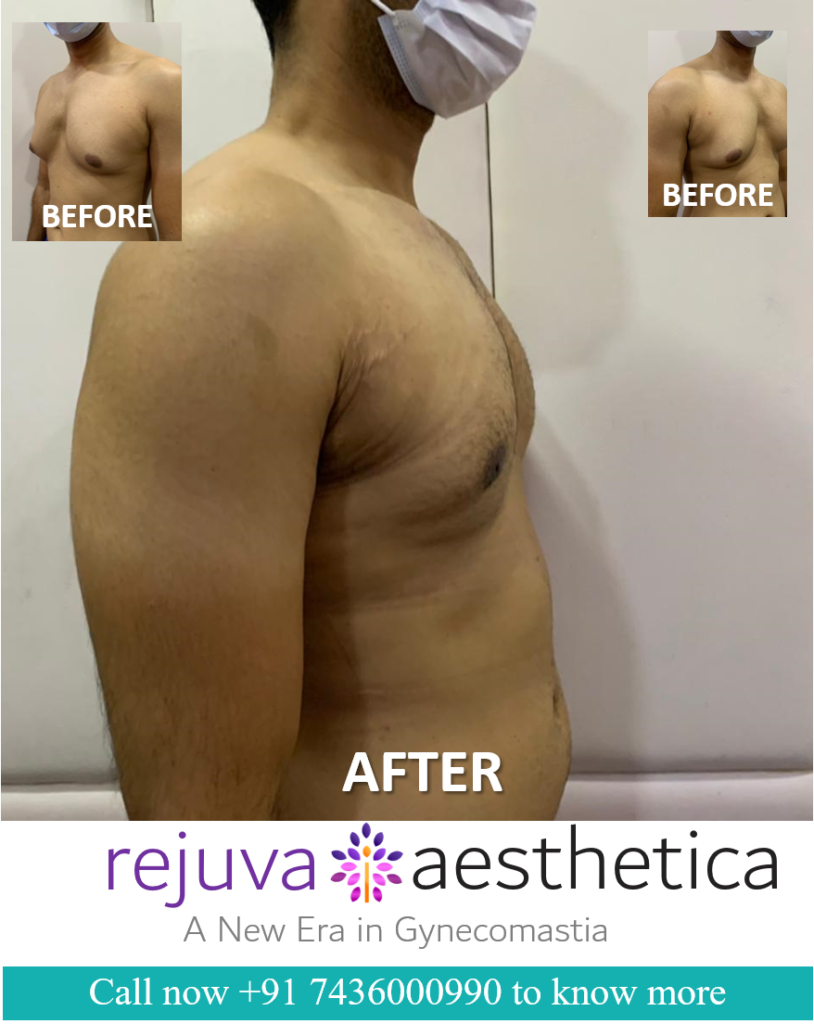 Gynecomastia (Enlarged Breast in Men) Surgery in Gujarat India