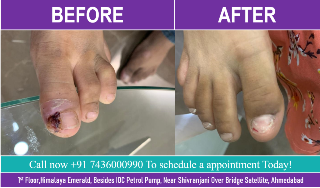 Ingrown Toenail Removal Surgery in Ahmedabad