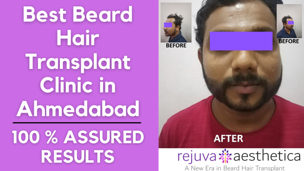 Beard Hair Transplant in Ahmedabad by Plastic Surgeon Dr Arth Shah
