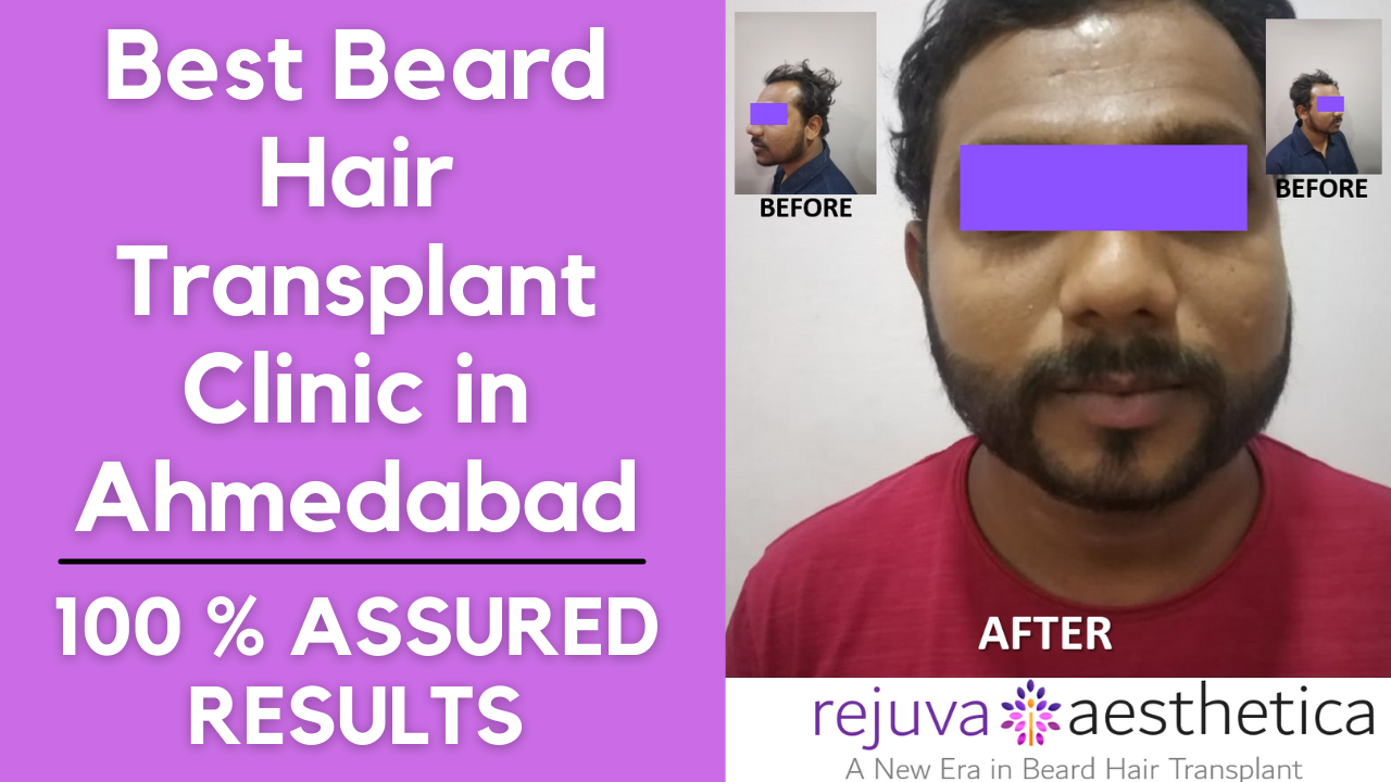 Best Beard Hair Transplant in Ahmedabad Gujarat