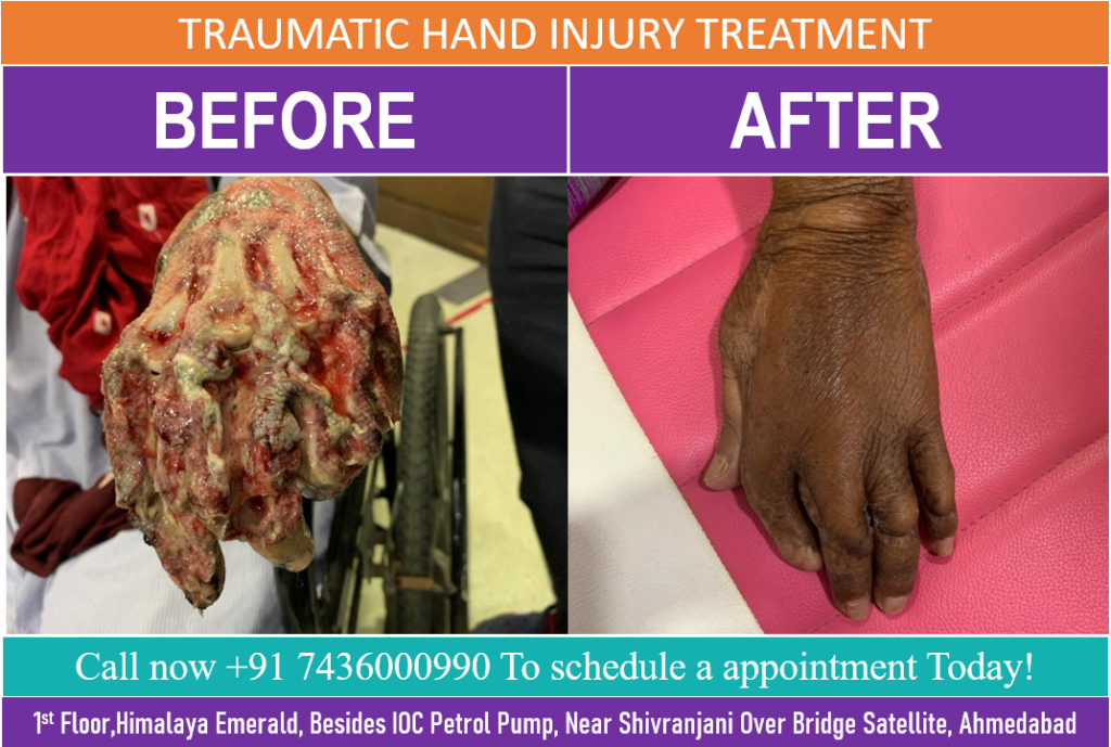 Skin Graft Surgery performed by Dr Arth Shah to treatment a severe Traumatic Injury