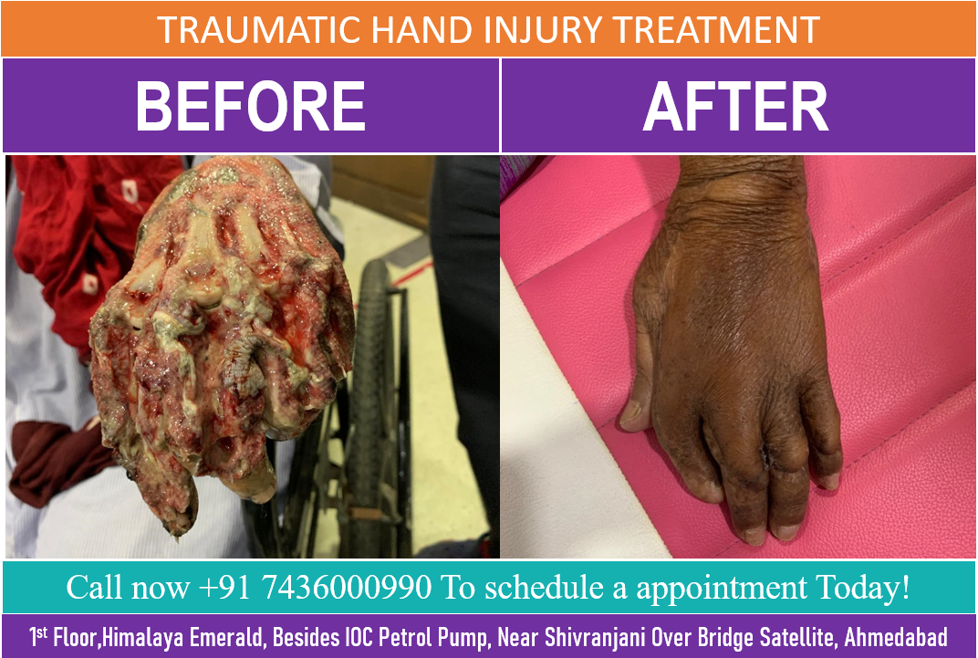 Traumatic hand Injury Treatment in Ahmedabad