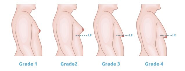 What are the Grades of Gynecomastia