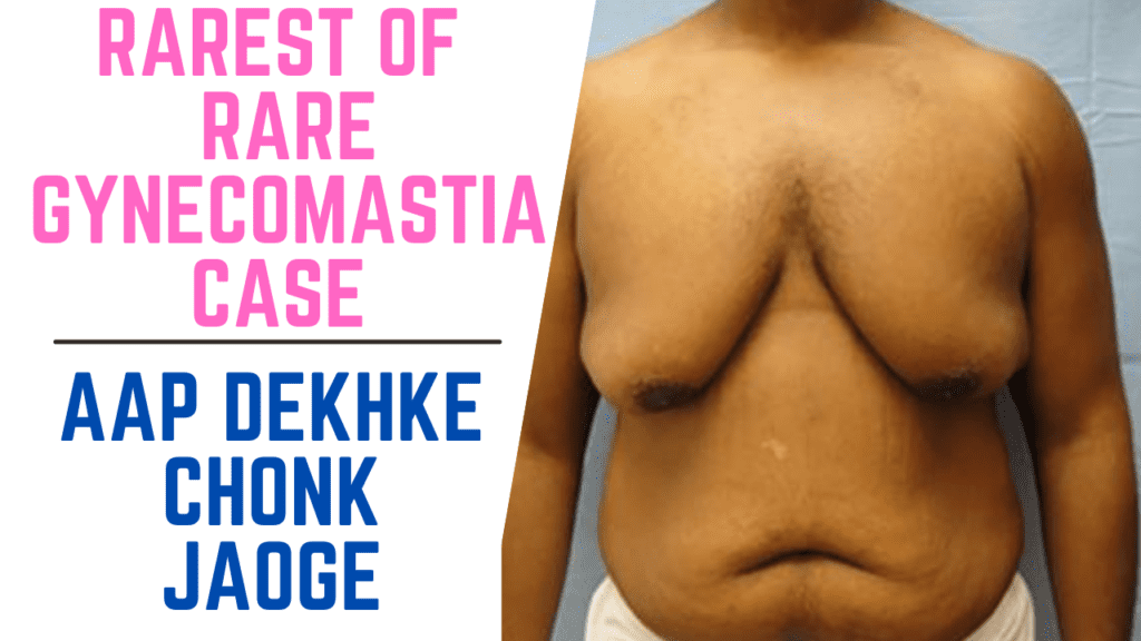 Rarest of rare case of gynecomastia | Aap Dekhke Chonk Jaoge #gynecomastiacase