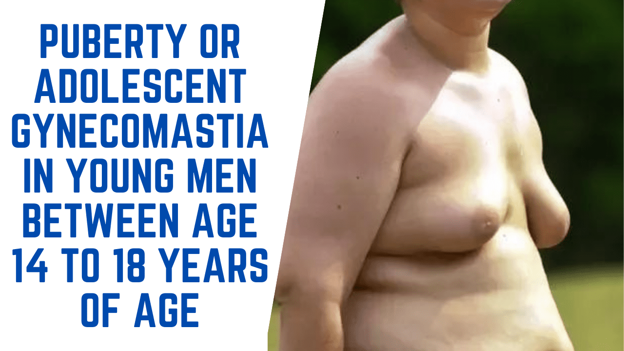 Puberty or adolescent Gynecomastia in Young Men between age 14 to 18 of age
