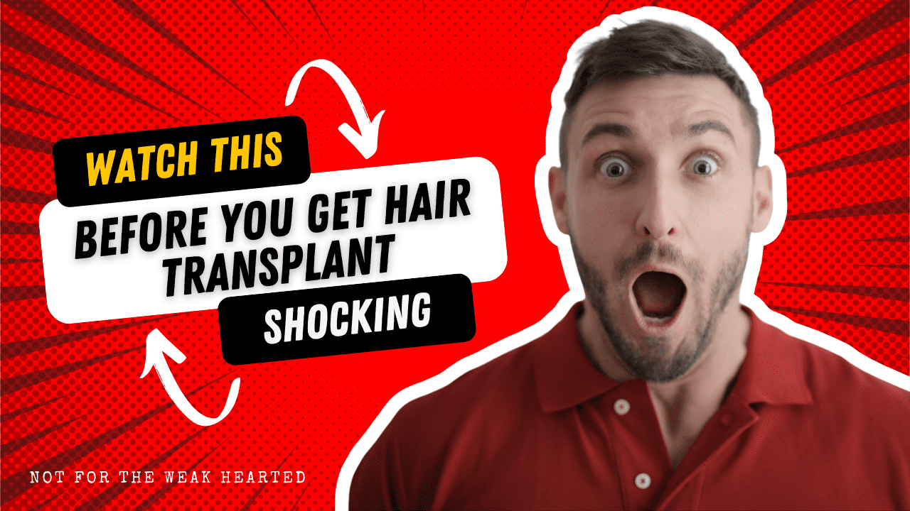 Be careful before you get hair transplant from a non qualified doctor