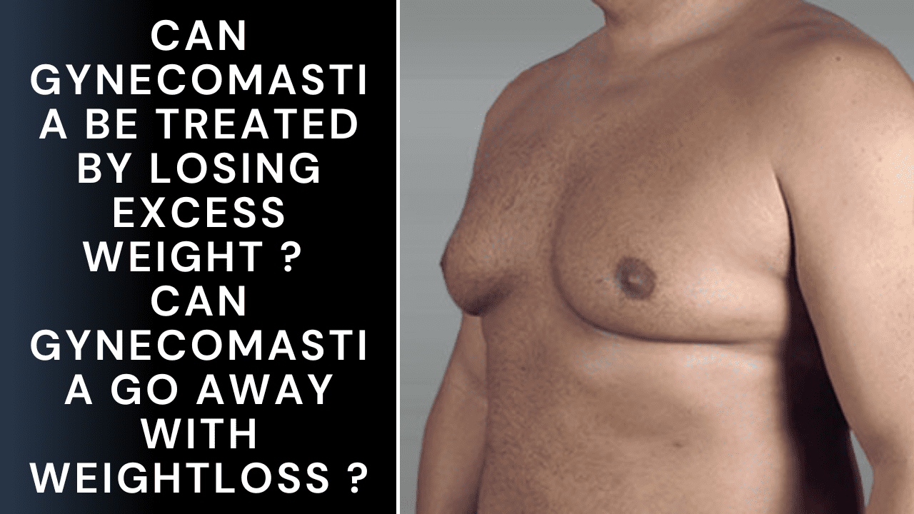 Can gynecomastia be treated by losing excess weight Can gynecomastia go away with weightloss