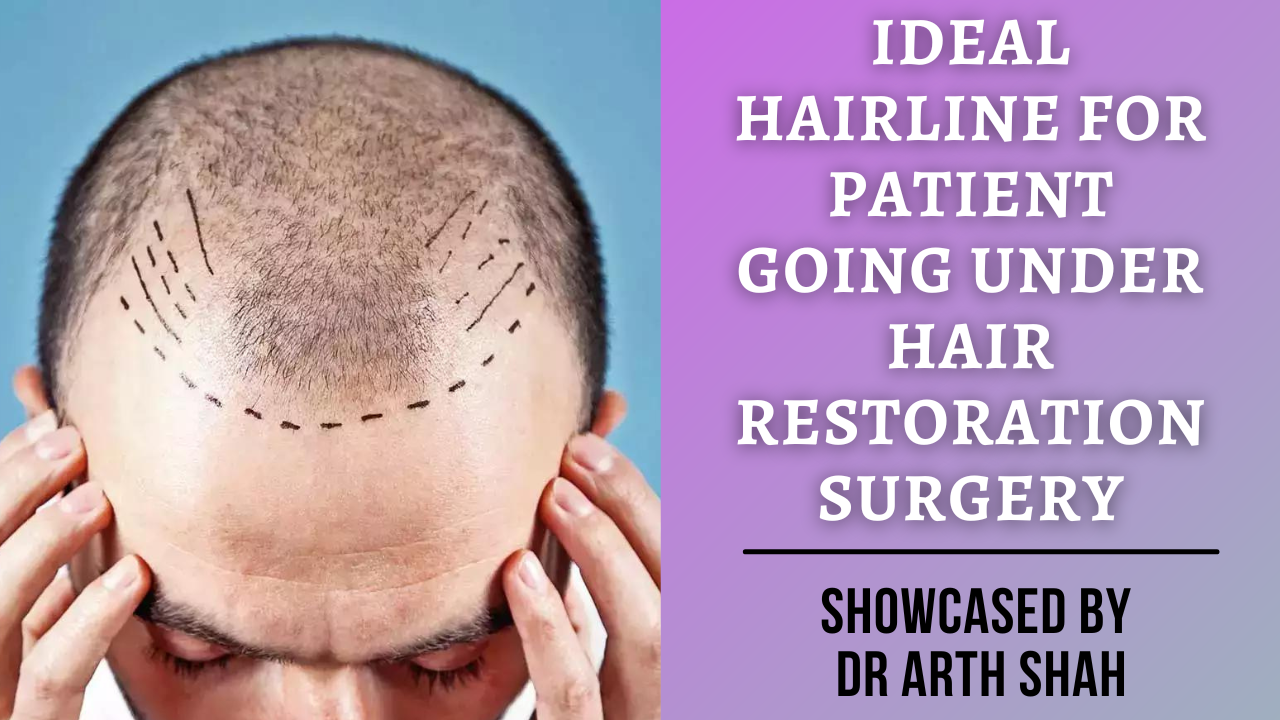 Ideal hairline for patient going under hair restoration surgery in Ahmedabad by Dr Arth Shah.