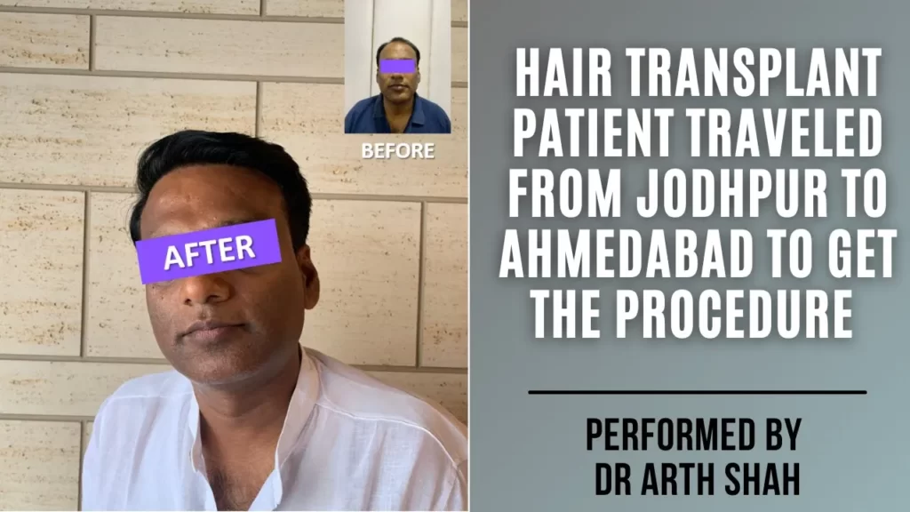 Hair Transplant in Ahmedabad: Patient Travels from Jodhpur for Expert Hair Restoration
