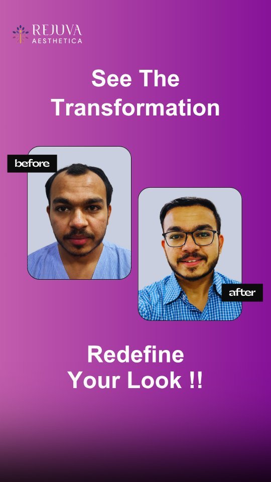 Before and after Hair Transplant in Ahmedabad, Gujarat showing visible hair regrowth and improved hairline