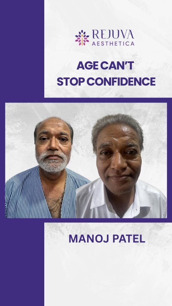 Hair Transplant in Ahmedabad, Gujarat before and after result showing successful hair restoration transformation