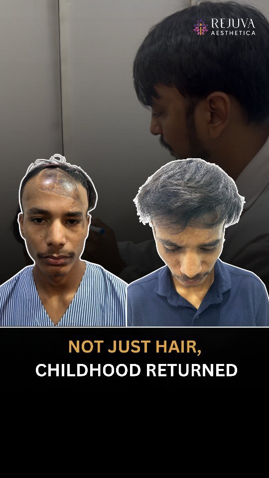 Best Hair Transplant in Ahmedabad, Gujarat before and after results with thick natural hair