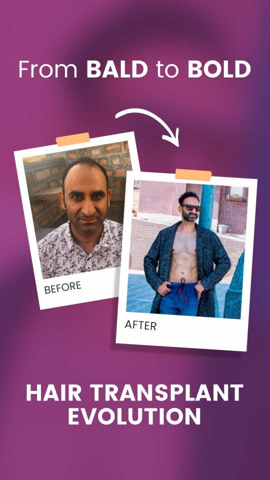 Hair Transplant in Ahmedabad, Gujarat transformation showing crown area hair regrowth